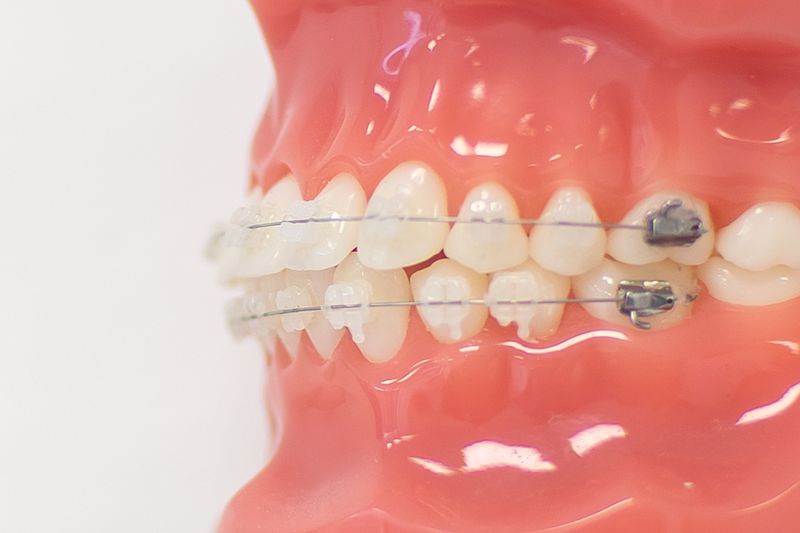 How Much Do Braces Cost in Ireland? 